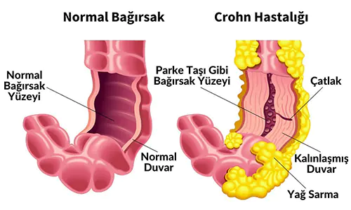 Crohn Hastaliği